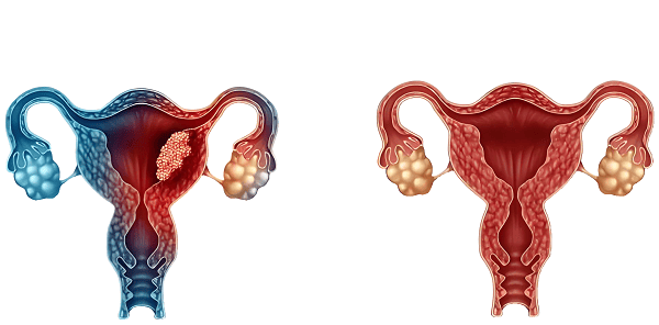 子宫内膜异位，痛经，Endometriosis ，Dysmenorrhea