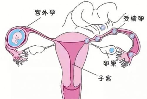 Causes of Ectopic Pregnancy, Reasons for Ectopic Pregnancy, Why Ectopic Pregnancy Happens, Ectopic Pregnancy, Ectopic Pregnancy