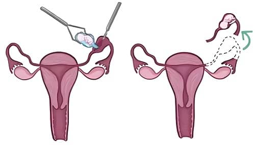 Ectopic pregnancy treatment, ectopic pregnancy, ectopic gestation, abnormal pregnancy, ectopic pregnancy surgery