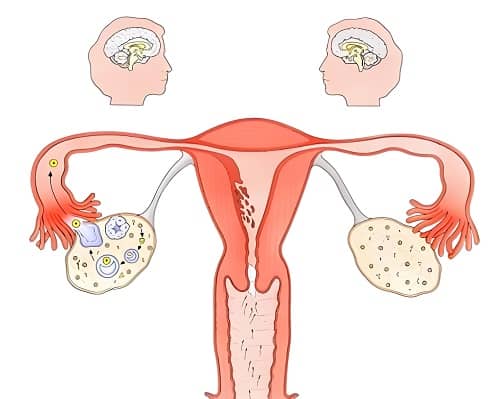 PCOS