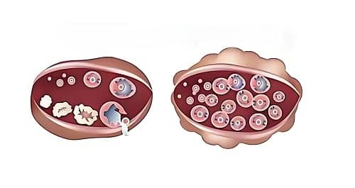 PCOS