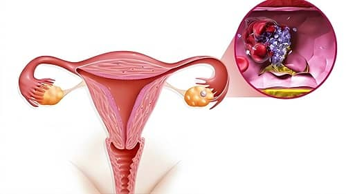 Causes of Endometriosis, What Problems Trigger Endometriosis, Endometriosis, Menstrual Pain, Factors Leading to Endometriosis